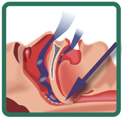 Apnée obstructive du sommeil