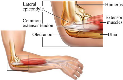 lateral epicondylitis or tennis elbow