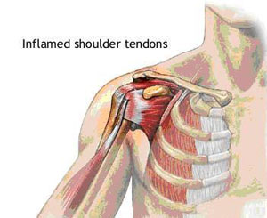 Shoulder tendonitis